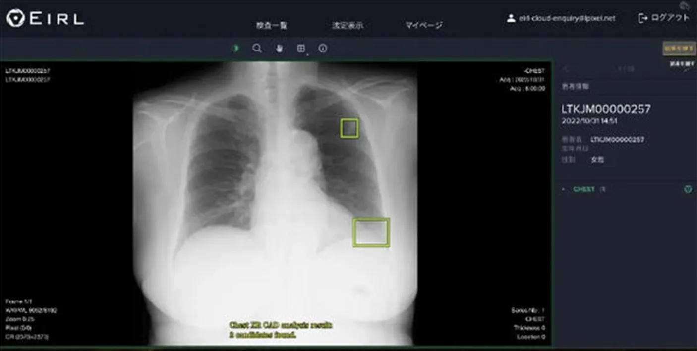 胸部レントゲンAI画像診断支援システム（エルピクセル社製 EIRL Chest）